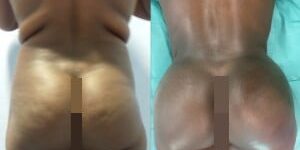 Brazilian-butt-lift-UK-specialist-300×225 Resultado de aumento de glúteos realizado en Marbella - España.