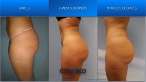 aumento de glúteos brasileño 1150cc antes — caso 19 Dr. Aslani Cirumed Marbella