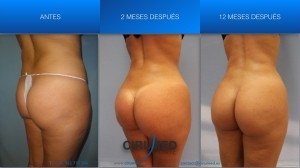 aumento de glúteos brasileño 1150cc resultado lateral — caso 19 Cirumed Marbella