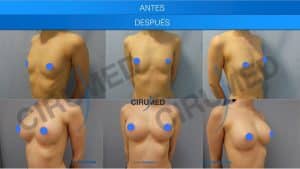 Aumento de pecho natural antes y después