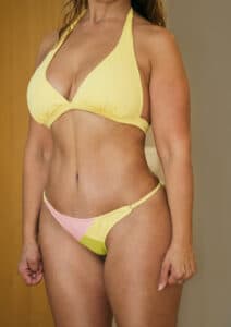 Abdominal liposuction results in Marbella - Spain.