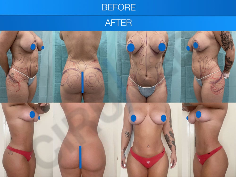 Lipoescultura abdominal