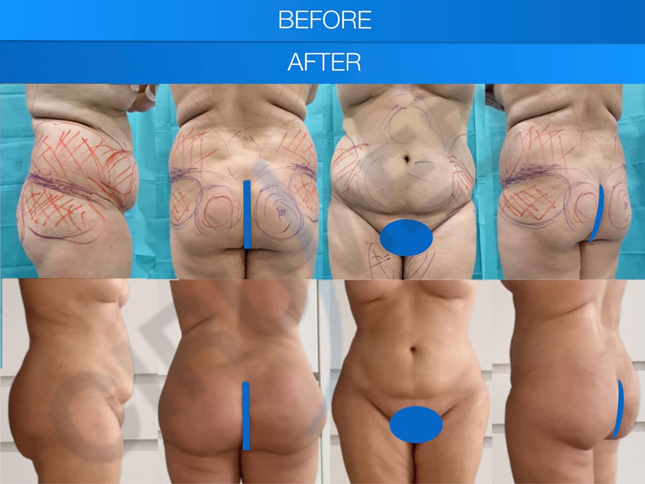 Miniabdominoplastia