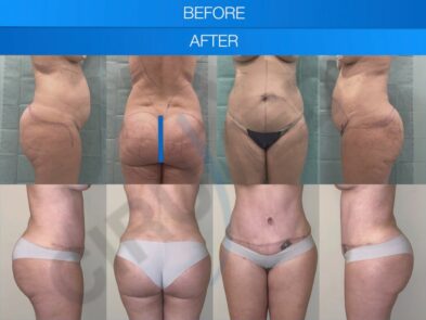 Resultados de liposucción abdominal en Marbella - España.