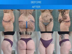 Resultado de una liposucción y aumento de glúteos (bbl) antes y después en Marbella - España.