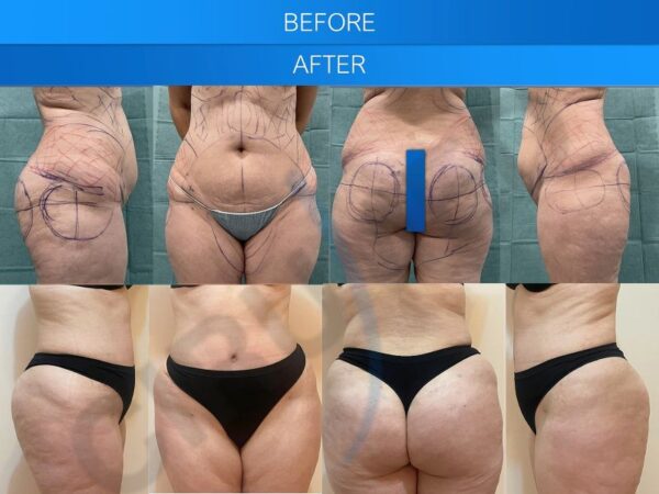 Resultados de una liposucción de abdomen y glúteos en Marbella - España.