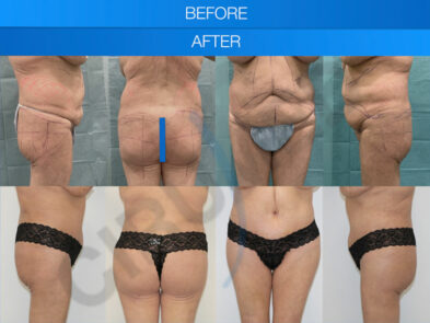 Antes y después de una liposucción realizada en Marbella - España.