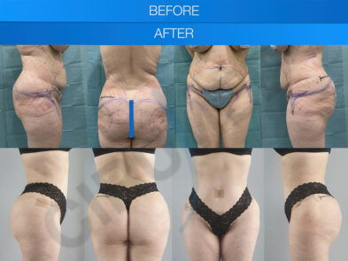 Resultados de una liposucción de abdomen y aumento de glúteos en Marbella - España.