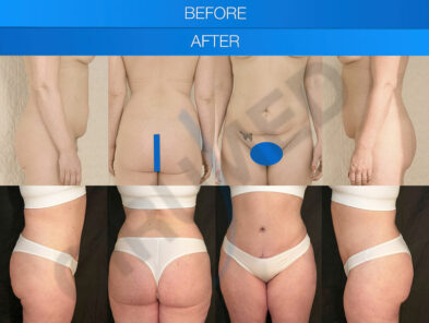Antes y después de una liposucción en Marbella - España.