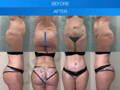 Antes y después de una liposucción realizada en Marbella - España.