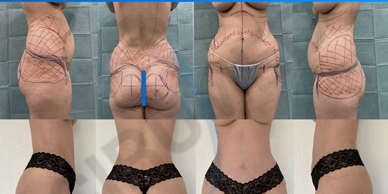 cirugía-para-abdomen-plano Resultado de un aumento de glúteos realizado en Marbella - España.