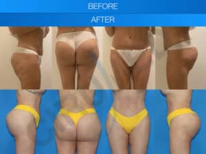 Abdominoplastia