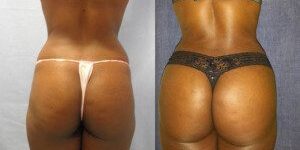 aumento-de-gluteos.21-300×250-300×250 Resultado de aumento de glúteos en Marbella - España.