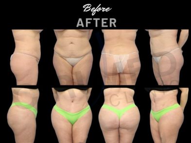 Before and after a liposuction procedure in Marbella, Spain.