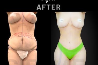 Resultado con cambio extremo de ribmold antes y después hecho por Dr. Aslani en Marbella - España