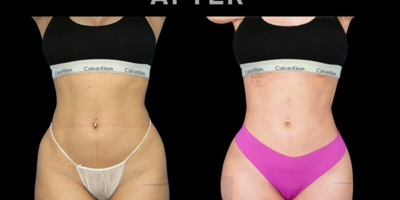 Resultado de Ribmold de mujer antes y después realizado por Dr. Aslani en Marbella - España