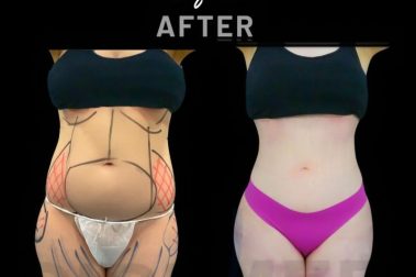 "Resultados de una liposucción abdominal en Marbella - España."