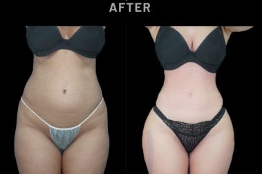 Ribmold en mujer antes y después - resultado del Dr. Aslani en Marbella - España