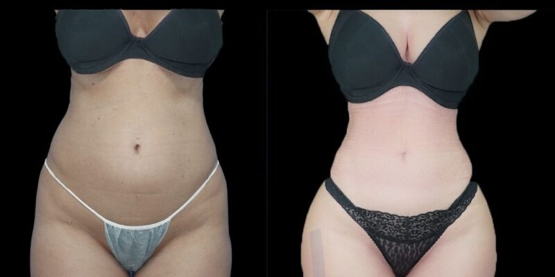 Ribmold en mujer antes y después - resultado del Dr. Aslani en Marbella - España