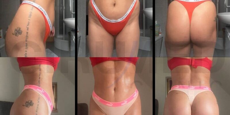 Supercharged 001 Resultado mujer con glúteo cuadrado de un aumento de glúteos antes y despues en Marbella - España