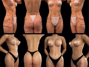 Antes y después con prótesis anatómicas