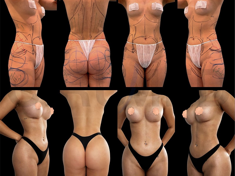 Aumento de pecho — Cirumed Clinic Marbella