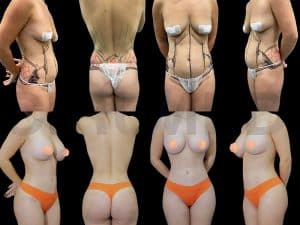 Antes y después de corrección de mamas tuberosas