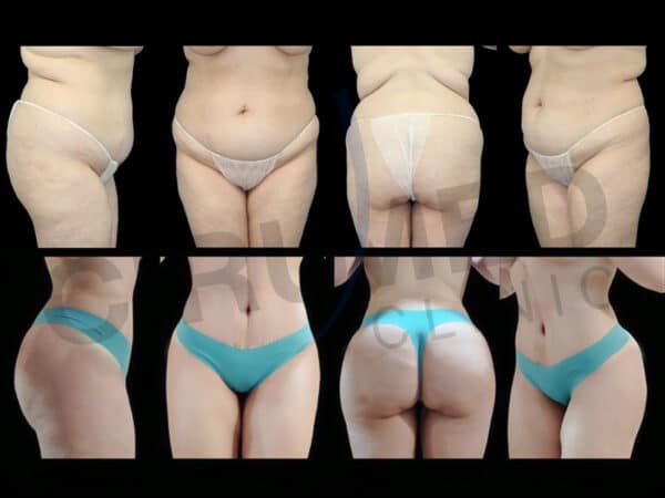 Resultado de liposucción y aumento de glúteos en Marbella - España.