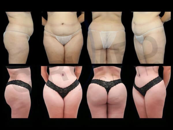 "Resultados de liposucción y aumento de glúteos en Marbella - España."
