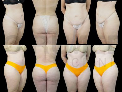 Resultado de una liposucción de abdomen y glúteos en Marbella - España.