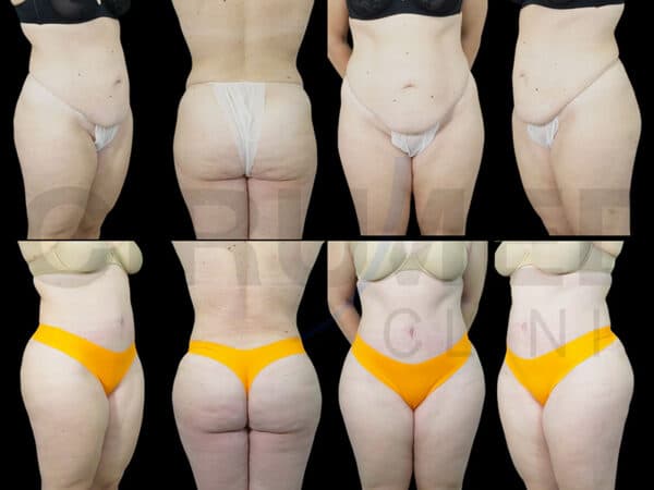 Resultado de una liposucción de abdomen y glúteos en Marbella - España.