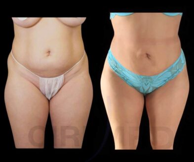 Resultado de una liposucción de abdomen en Marbella - España.