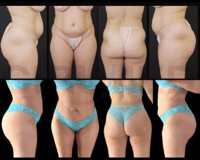 Antes y después de una liposucción de abdomen y glúteos en Marbella - España.