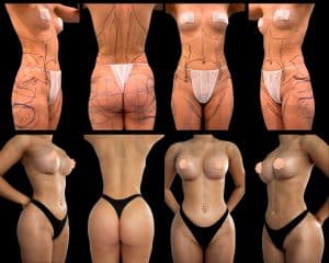 Liposucción de flancos antes y después — Cirumed Clinic Marbella