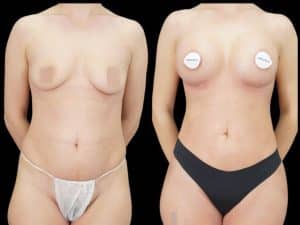 "Antes y después de un aumento de senos realizado en Cirumed Clinic, Marbella - España."