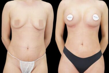 "Antes y después de un aumento de senos realizado en Cirumed Clinic, Marbella - España."