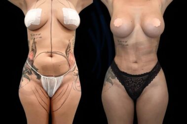 Antes y después de una mamoplastia de aumento realizada en Marbella - España.
