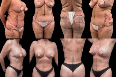 "Resultado de una cirugía de aumento de senos y liposucción en Marbella - España."