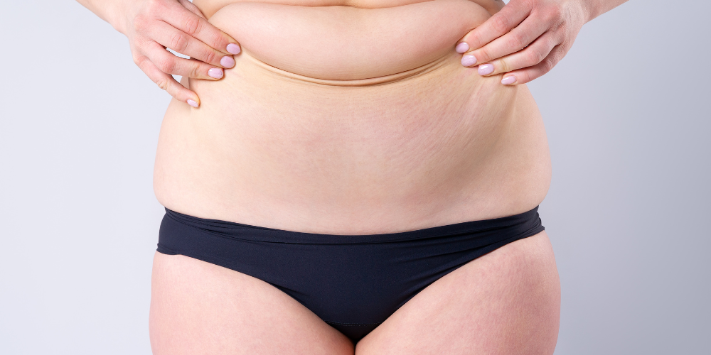 "Resultado de una liposucción abdominal en Marbella - España."