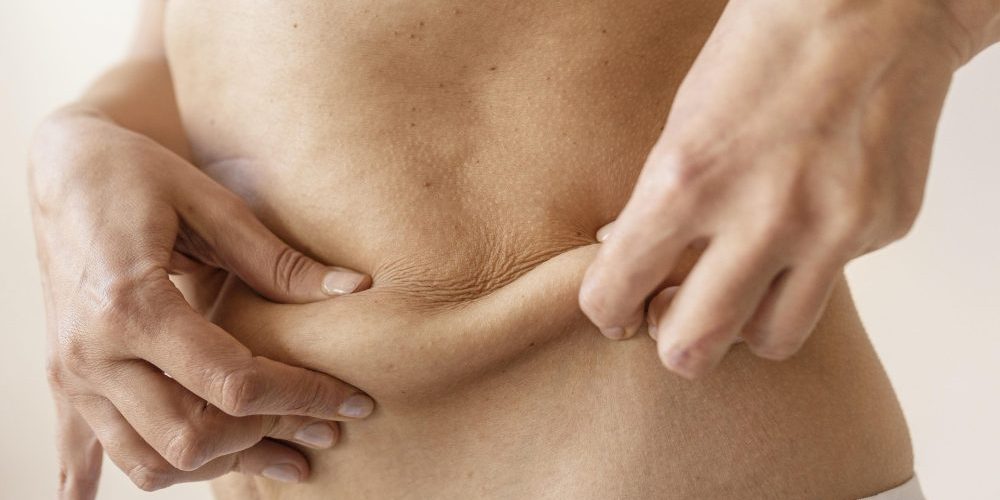 Resultado de una liposucción abdominal en Marbella - España.