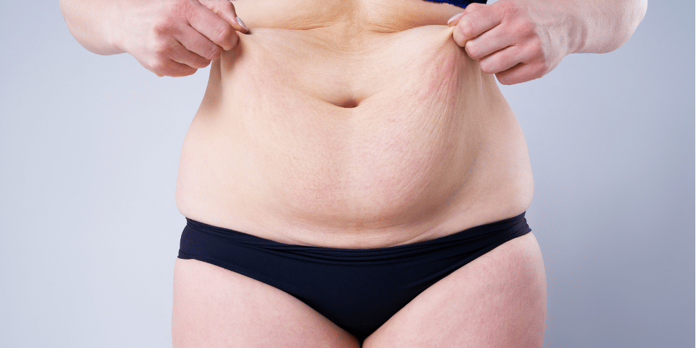 Resultado de una abdominoplastia en Marbella - España.