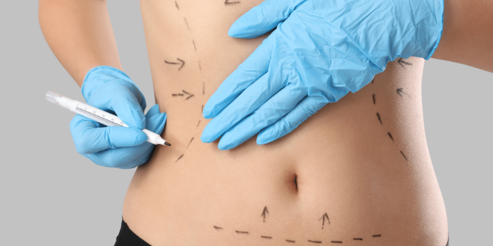 Marcación previa a una liposucción abdominal en Marbella - España.