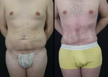 Results of abdominal liposuction in men in Marbella - Spain.