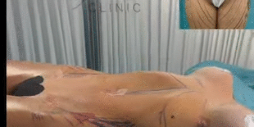 Lipo