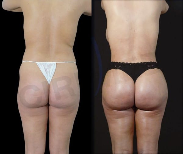 Resultado de Supercharged BBL con RibMold y liposcultura de alta definición en paciente delgada — Cirumed Marbella