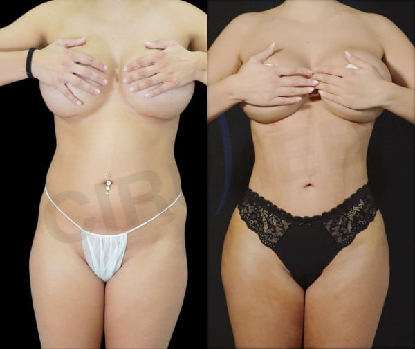 Marcaje de liposcultura 360° y RibMold antes del Supercharged BBL — Dr. Aslani Cirumed Marbella