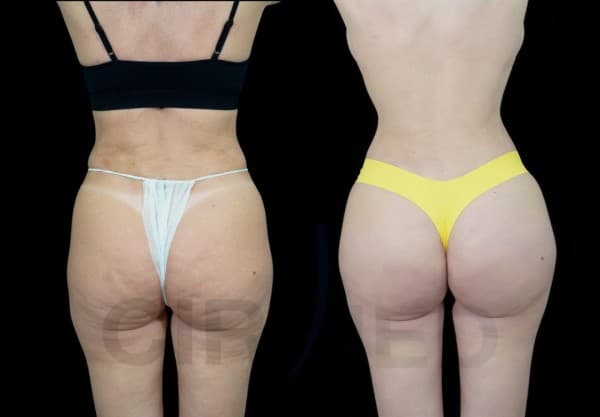 Caso clínico de feminización de cintura con remodelado costal sin implantes