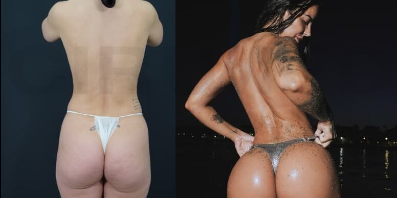 Antes y después de implantes de glúteos y BBL
