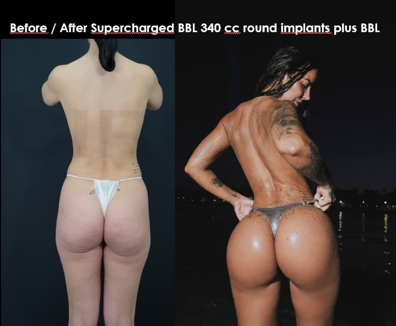 Antes y después de aumento glúteo con implantes cohesivos y técnica Supercharged BBL (implantes + injerto de grasa)