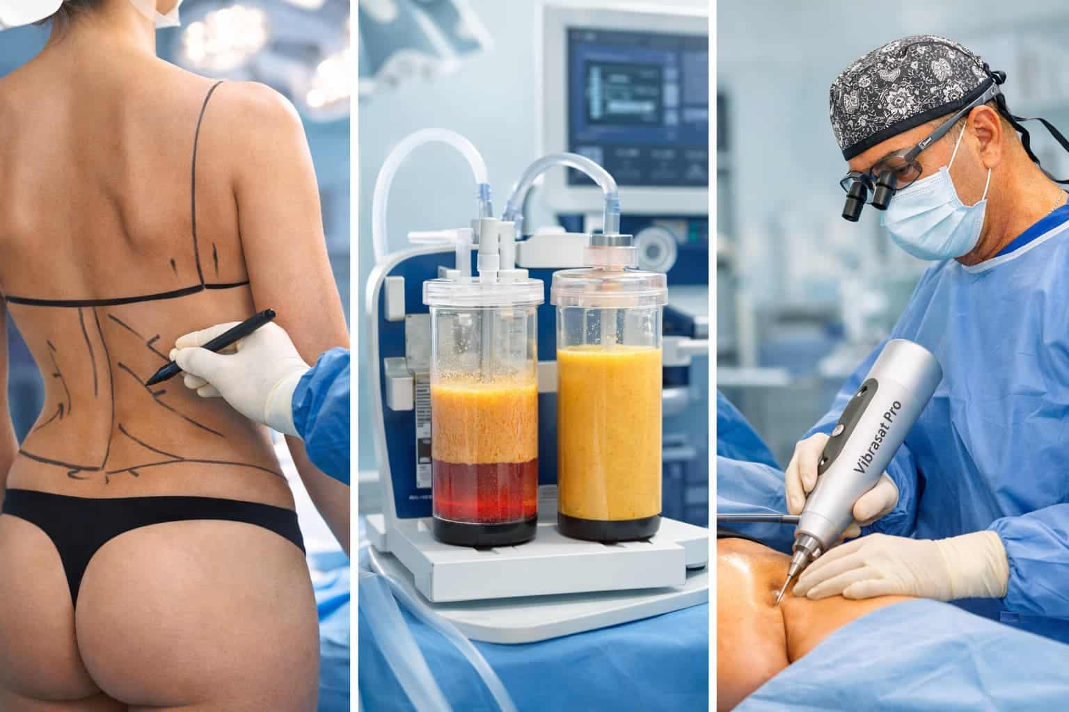 Composición médica de cirugía de contorno corporal: marcación preoperatoria, grasa extraída y cirujano realizando liposucción en quirófano.